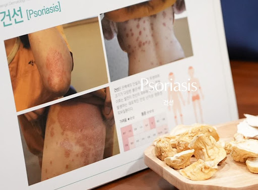 생기한의원 건선 페이지에서 확인하는 홍피성 건선 기본 특징